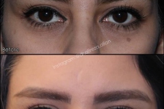 01-eyelid