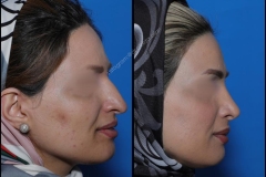 nose-surgery-0021