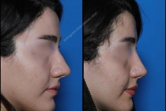 nose-surgery-0042