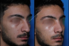 nose-surgery-0044