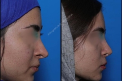 nose-surgery-0051
