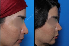 nose-surgery-0057