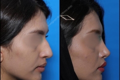 nose-surgery-0063