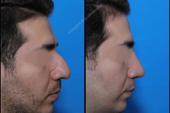 nose-surgery-0079