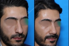 nose-surgery-0091