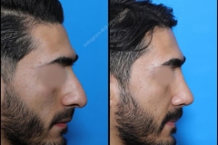 nose-surgery-0092