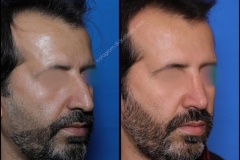 nose-surgery-0351