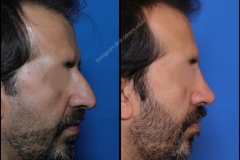 nose-surgery-0352