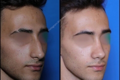 nose-surgery-0354