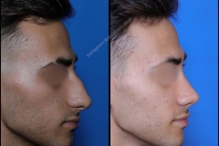 nose-surgery-0355