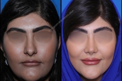 nose-surgery-0356