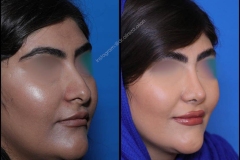 nose-surgery-0357