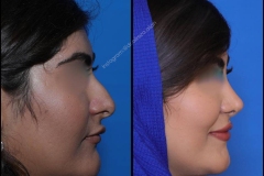 nose-surgery-0358