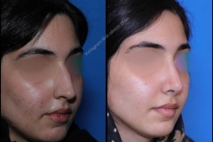 nose-surgery-0363