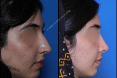 nose-surgery-0364