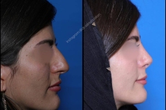 nose-surgery-0367