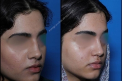 nose-surgery-0369