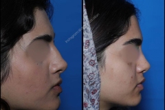 nose-surgery-0370