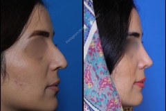 nose-surgery-0379
