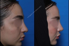 nose-surgery-0385