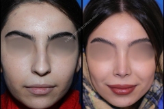 nose-surgery-0392