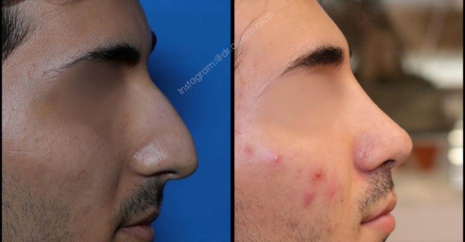Scar formation after nose surgery