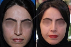 nose-surgery-0001