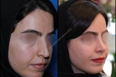 nose-surgery-0002