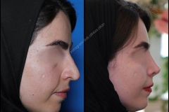 nose-surgery-0003