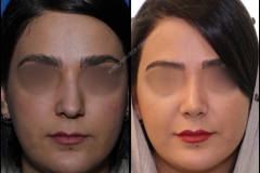 nose-surgery-0004