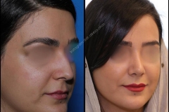 nose-surgery-0005