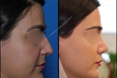 nose-surgery-0006