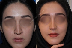 nose-surgery-0007