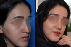 nose-surgery-0008