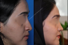 nose-surgery-0009