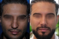nose-surgery-0010