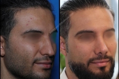 nose-surgery-0011