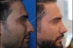 nose-surgery-0012