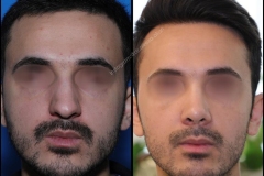 nose-surgery-0013