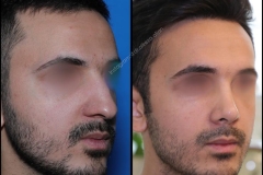 nose-surgery-0014