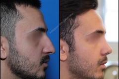 nose-surgery-0015