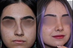 nose-surgery-0016