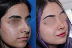 nose-surgery-0017
