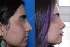 nose-surgery-0018