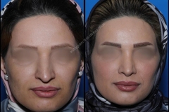 nose-surgery-0019
