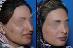 nose-surgery-0020