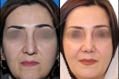 nose-surgery-0022