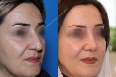 nose-surgery-0023