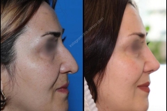 nose-surgery-0024