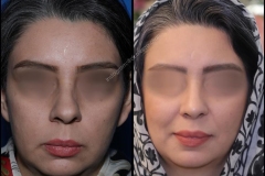 nose-surgery-0025